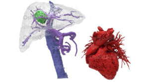 Patient Specific 3D Printed Organs