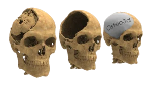 Cranial flap reshaping mold