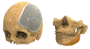 Custom cranial implant design