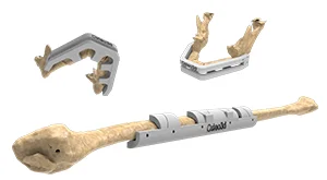 Patient-specific surgical guide