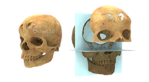 Virtual surgical planning 3D model